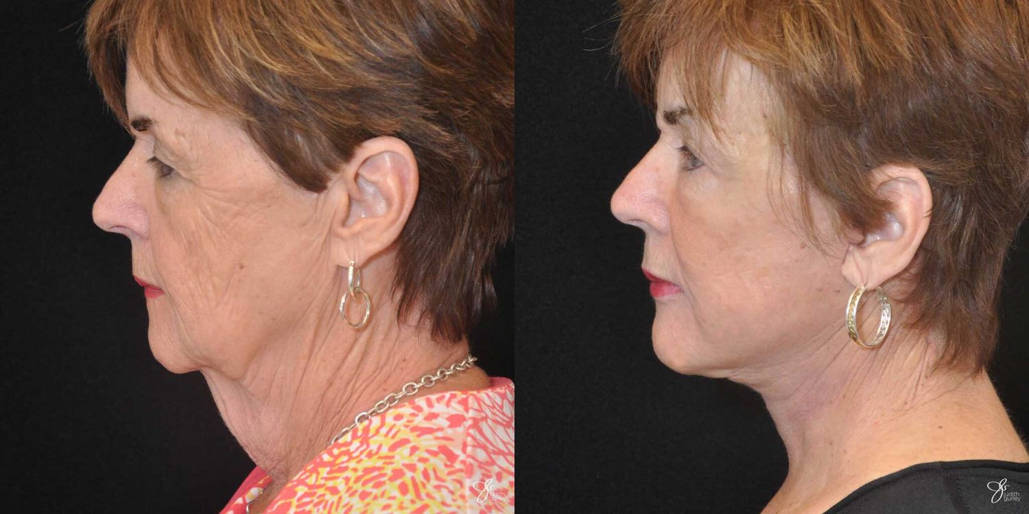 Face And Neck Lifts Before & After