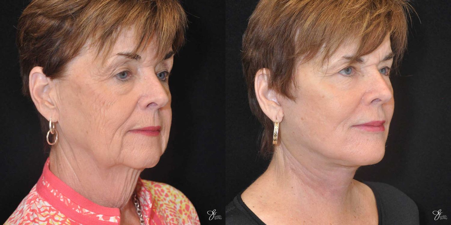 Face And Neck Lifts Before & After