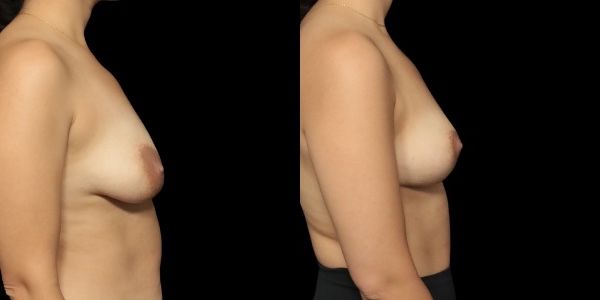 Areola Reduction Before & After