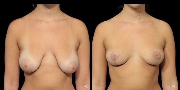 Areola Reduction Before & After