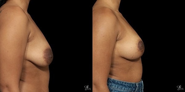 Areola Reduction Before & After