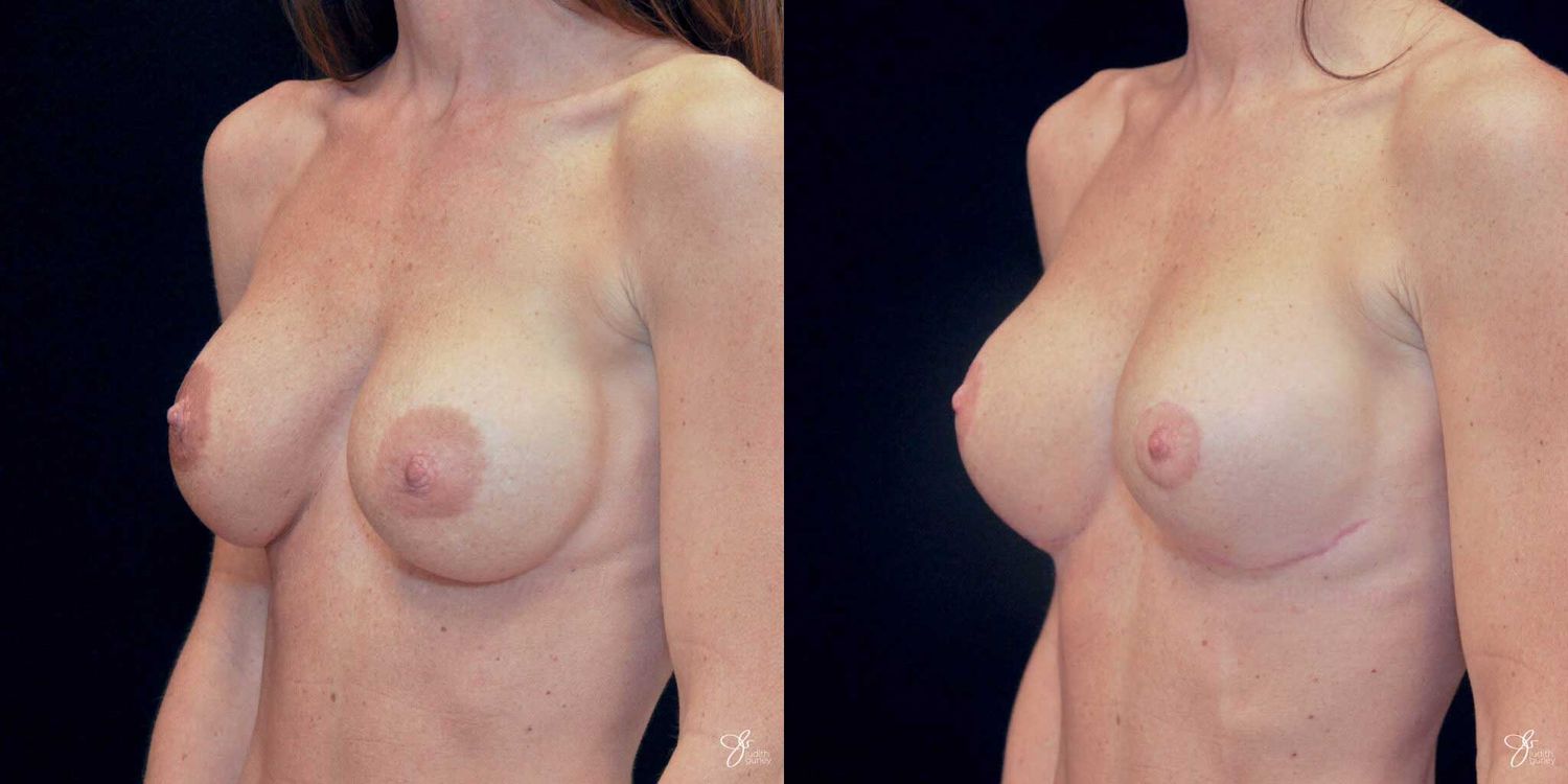 Areola Reduction Before & After