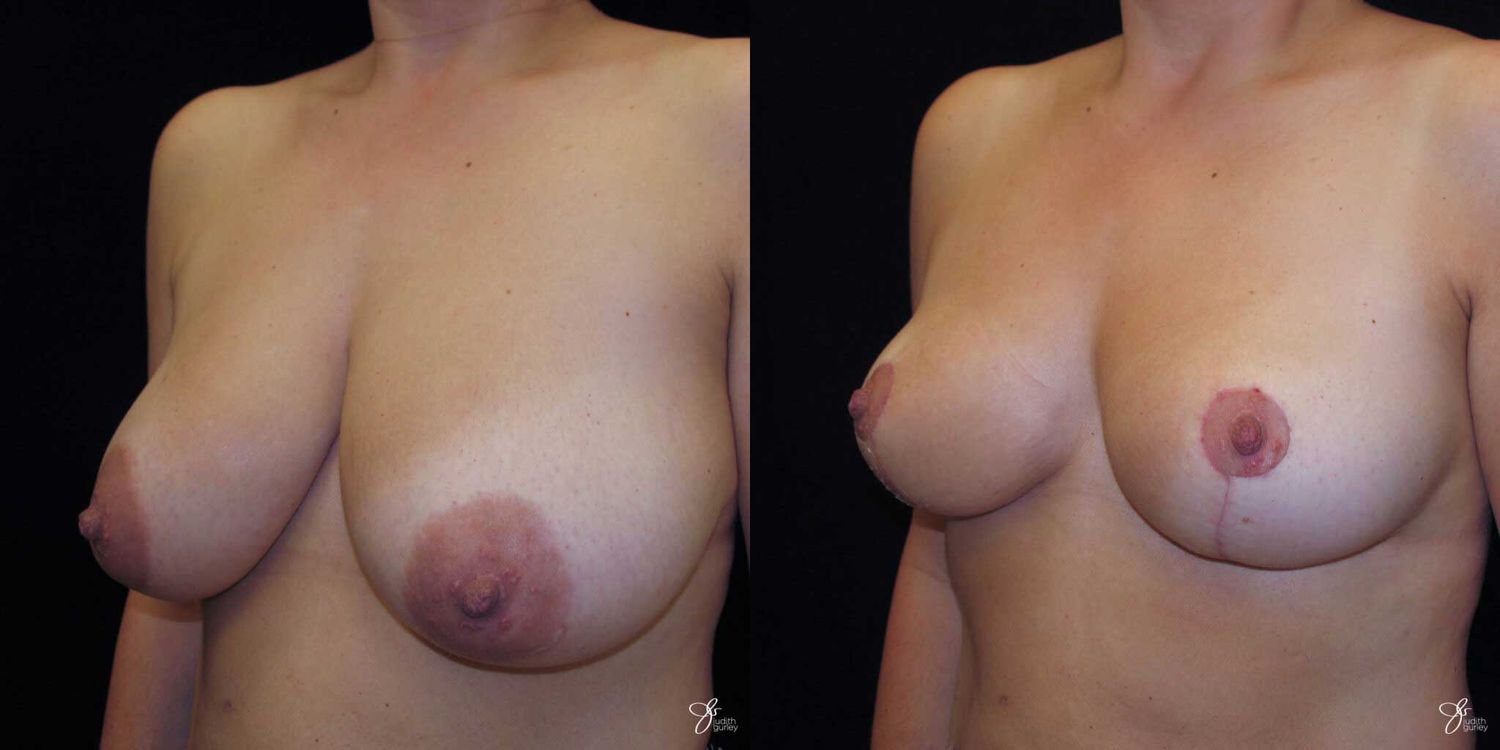 Areola Reduction Before & After