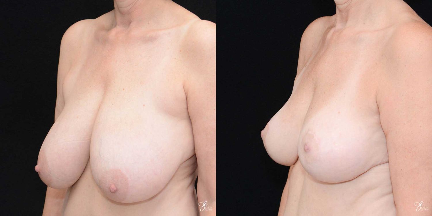 Areola Reduction Before & After