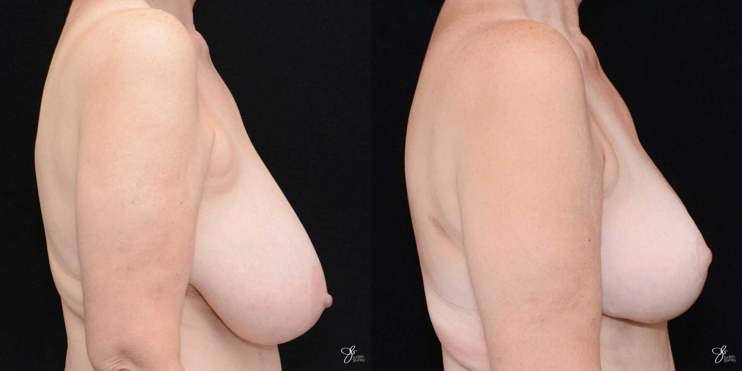 Areola Reduction Before & After