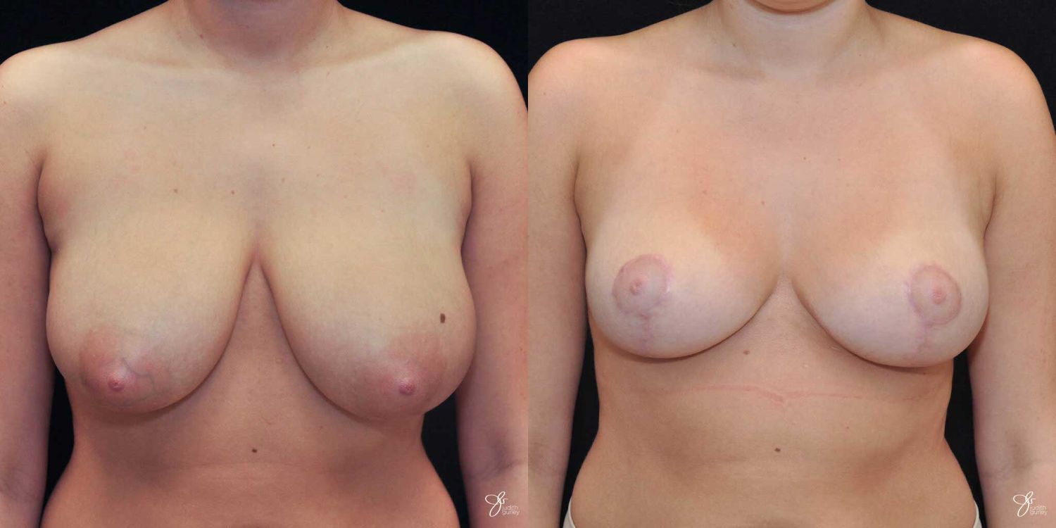Areola Reduction Before & After