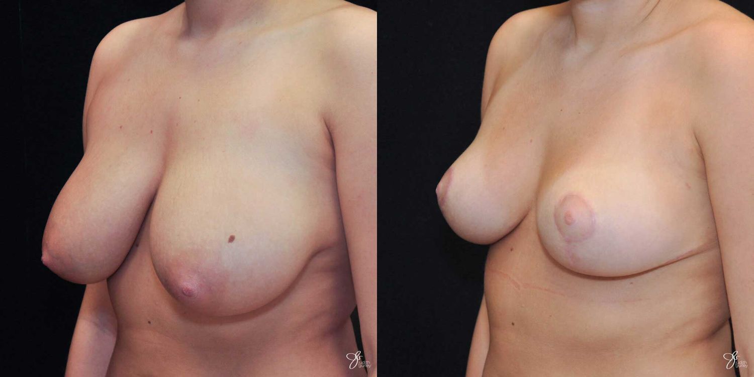 Areola Reduction Before & After