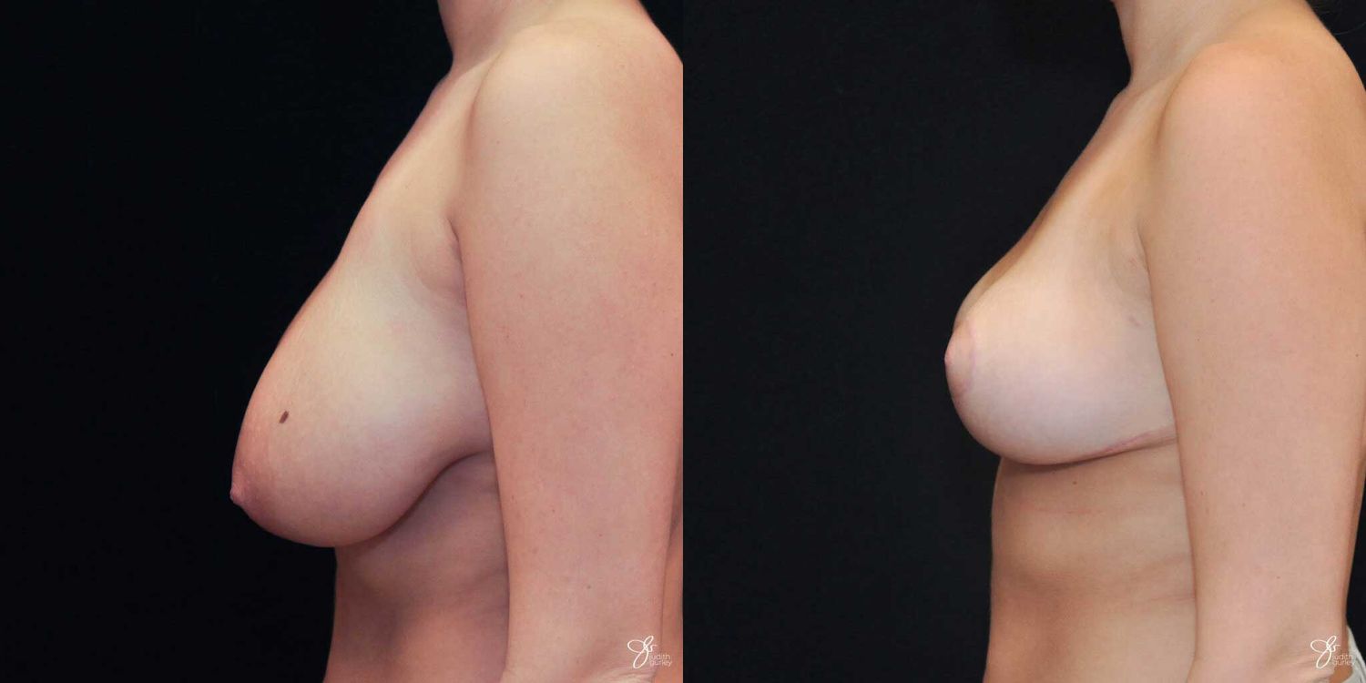 Areola Reduction Before & After