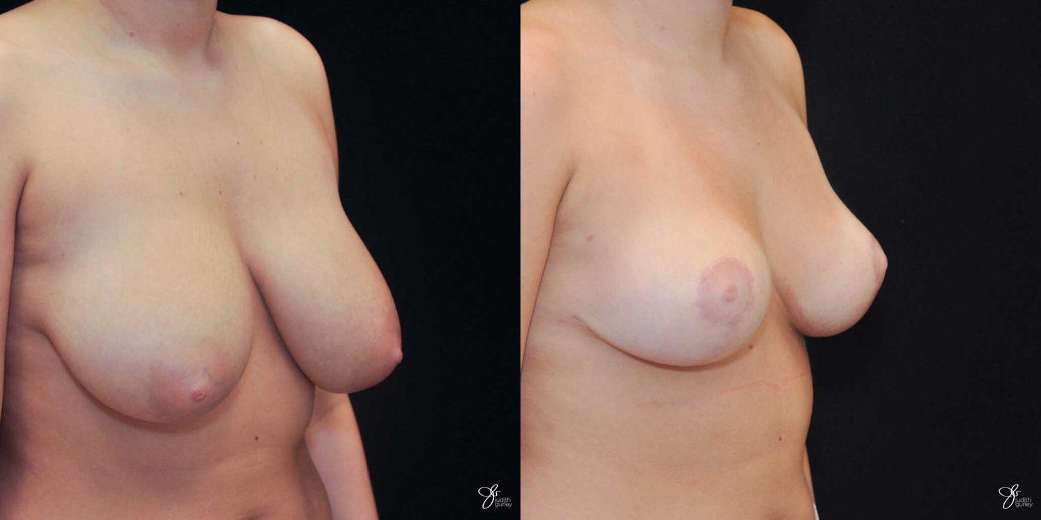 Areola Reduction Before & After