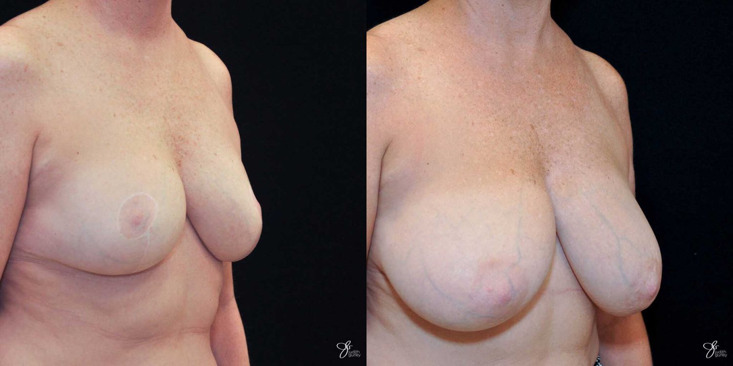 Areola Reduction Before & After