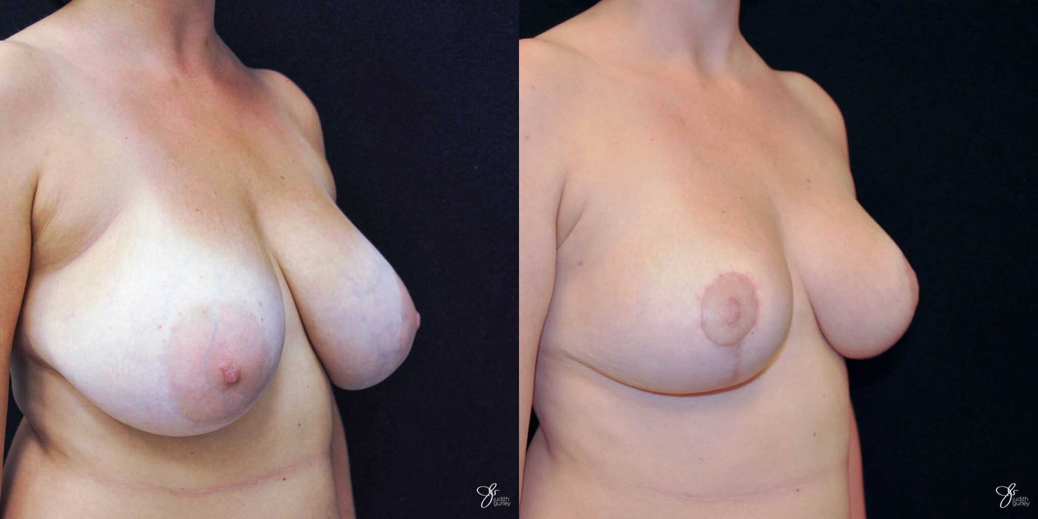 Areola Reduction Before & After