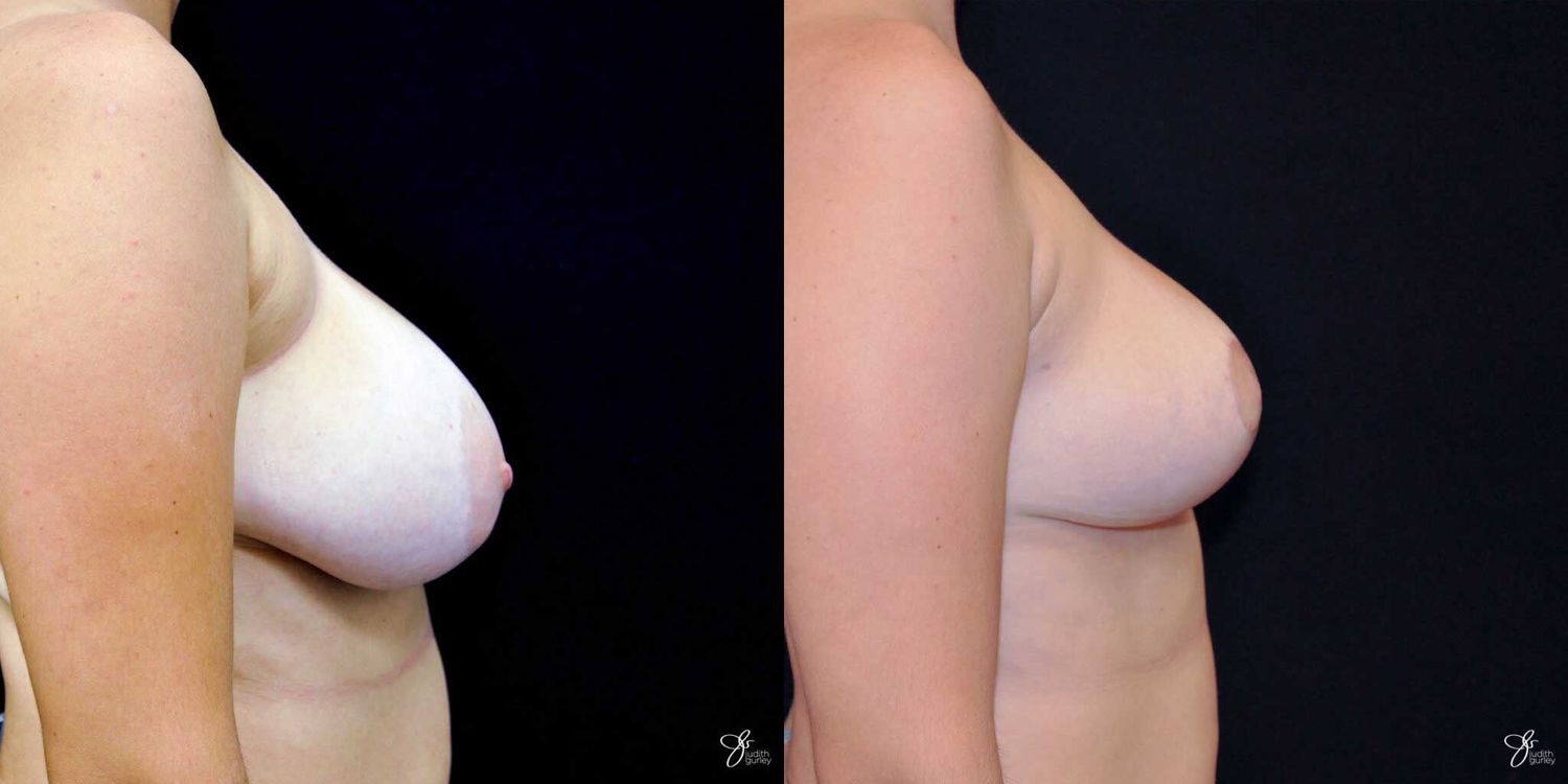 Areola Reduction Before & After