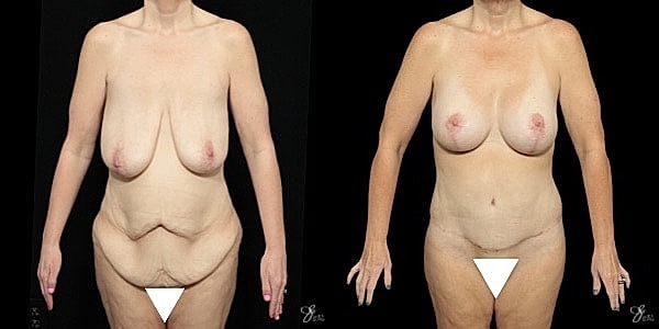Body Lift Before & After