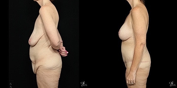 Body Lift Before & After