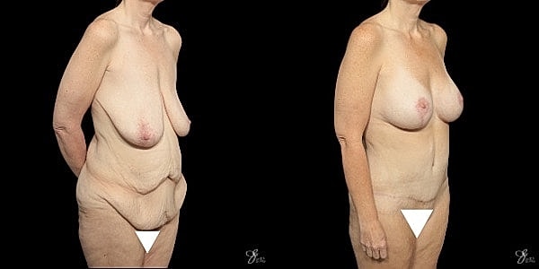 Body Lift Before & After