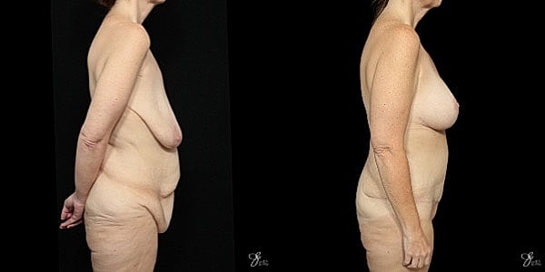 Body Lift Before & After
