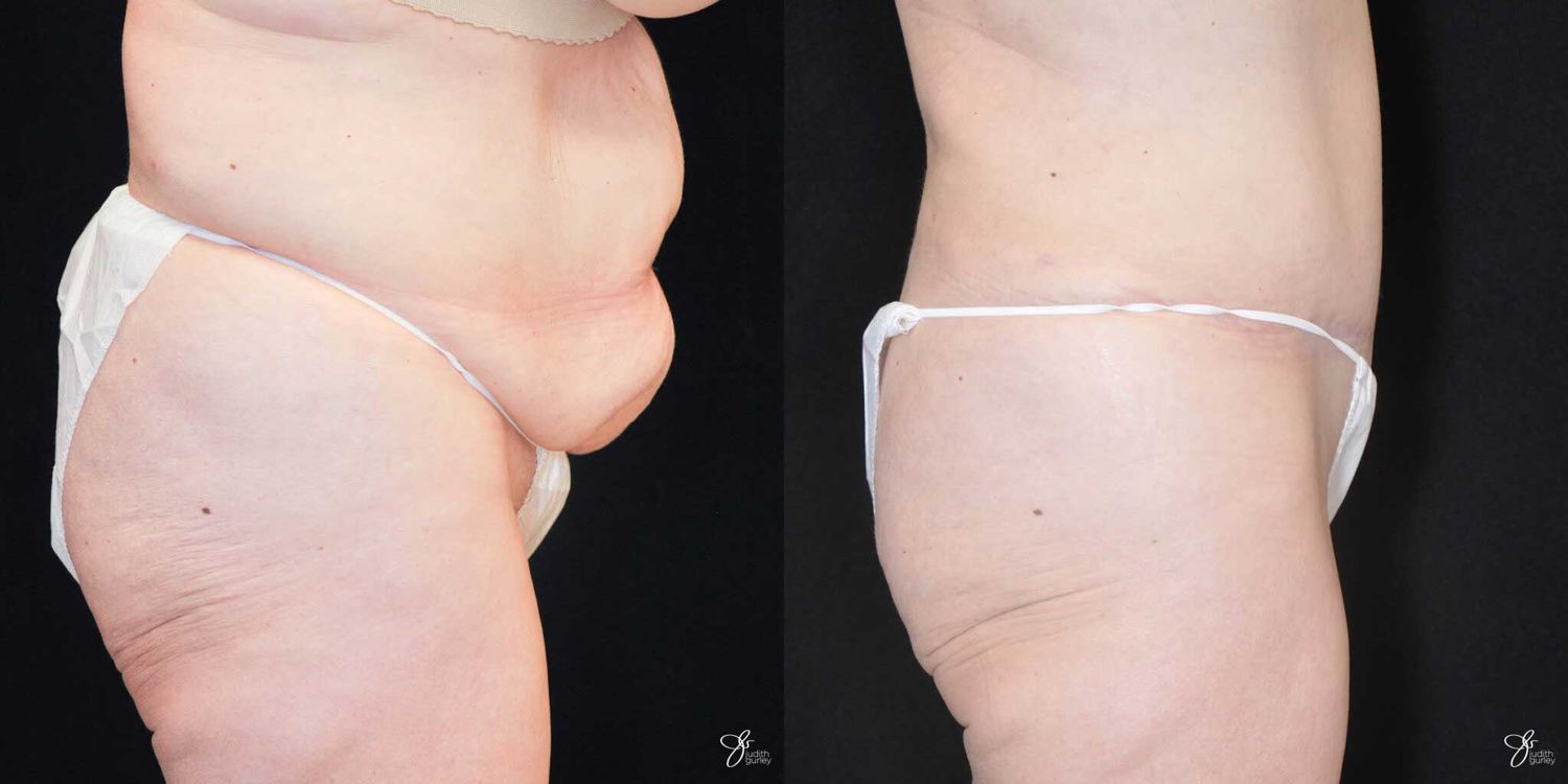 Body Lift Before & After