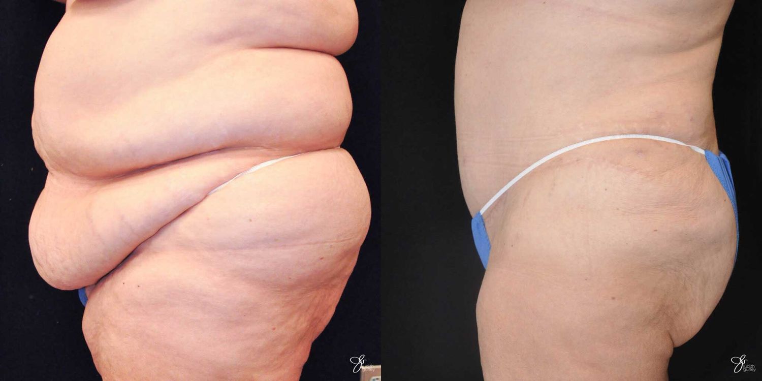 Body Lift Before & After