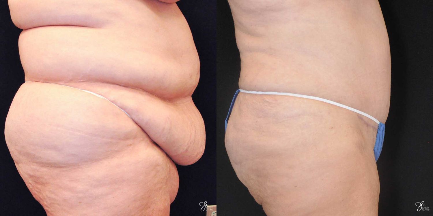 Body Lift Before & After