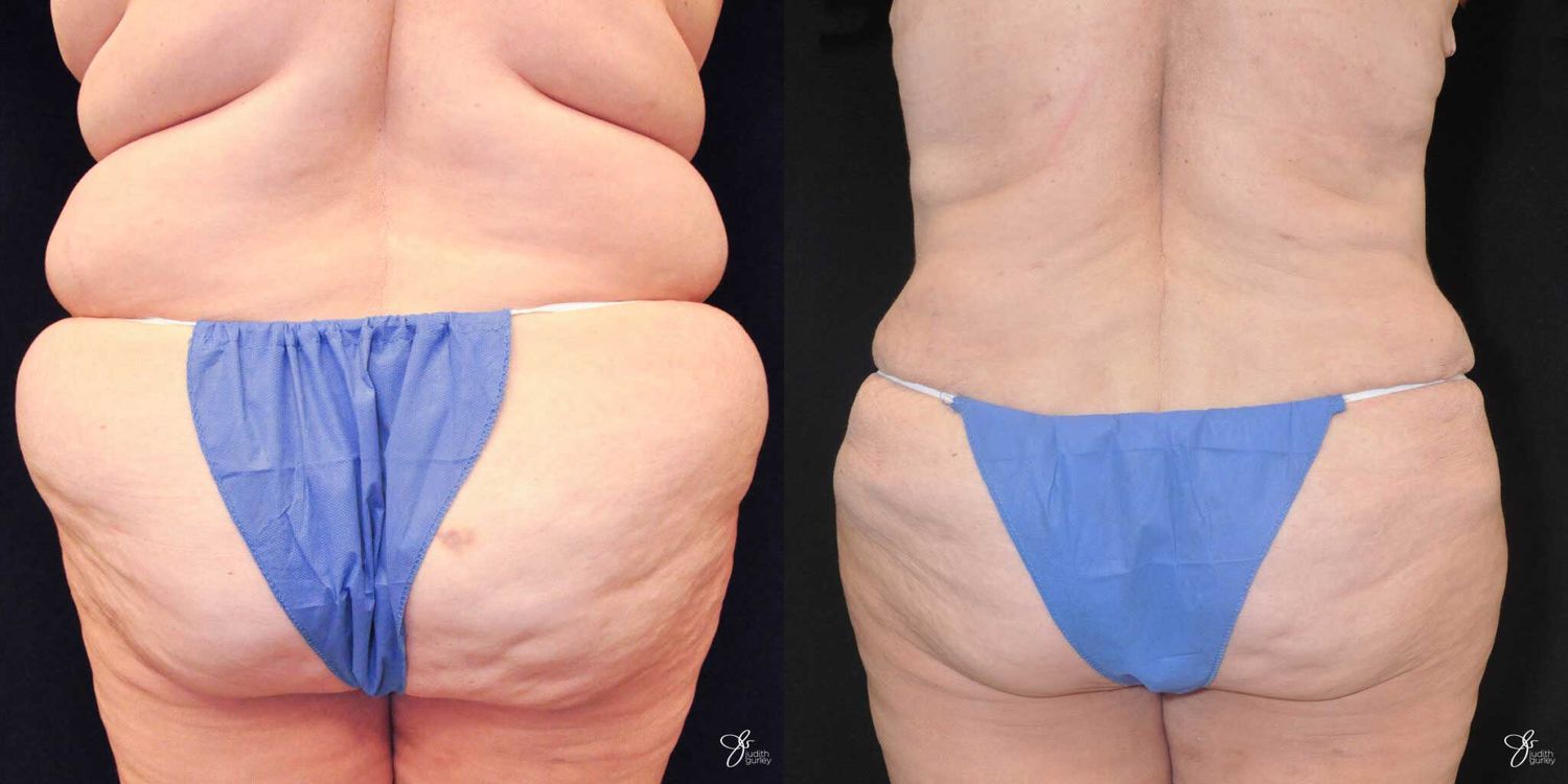 Body Lift Before & After