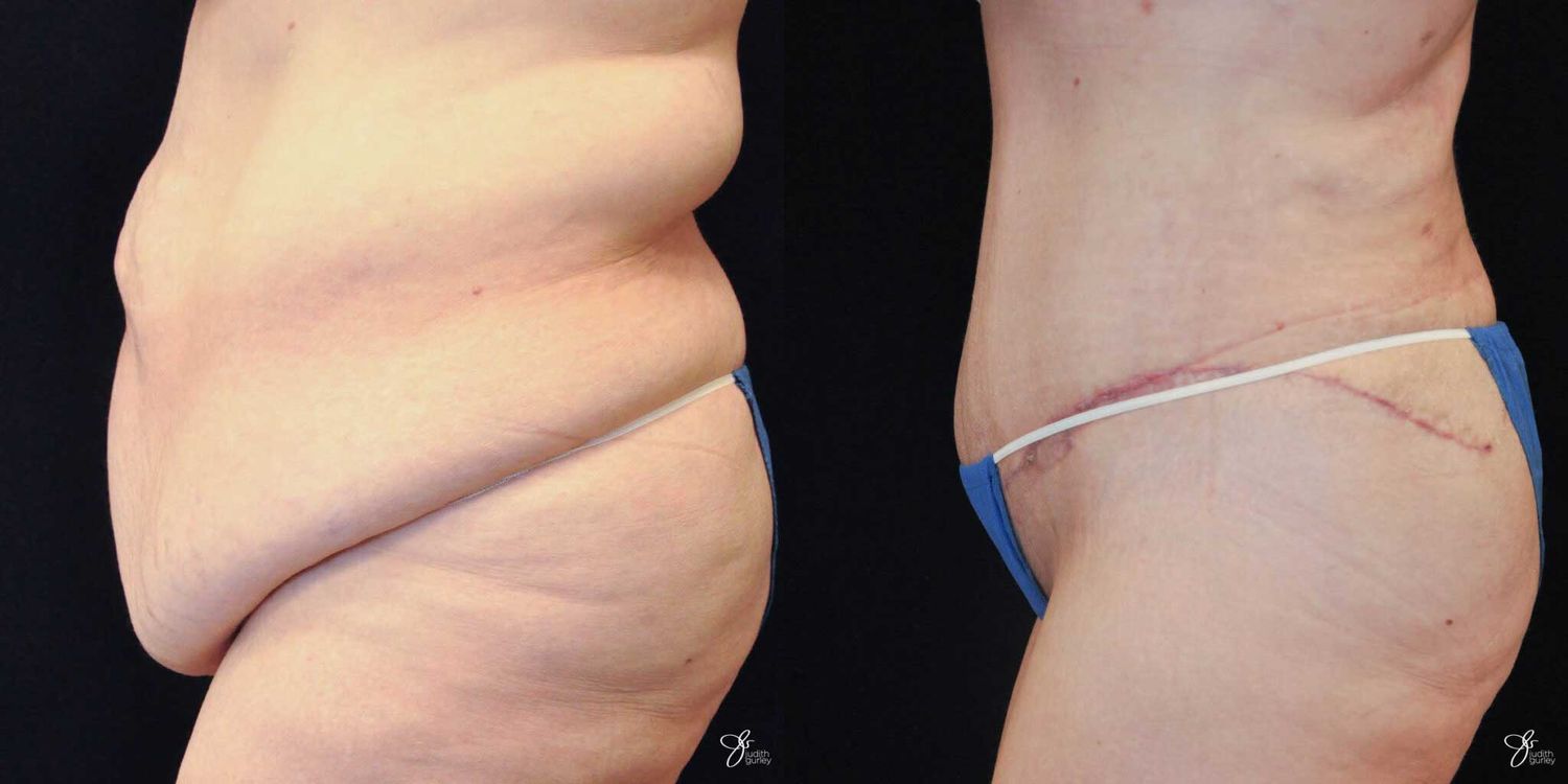 Body Lift Before & After