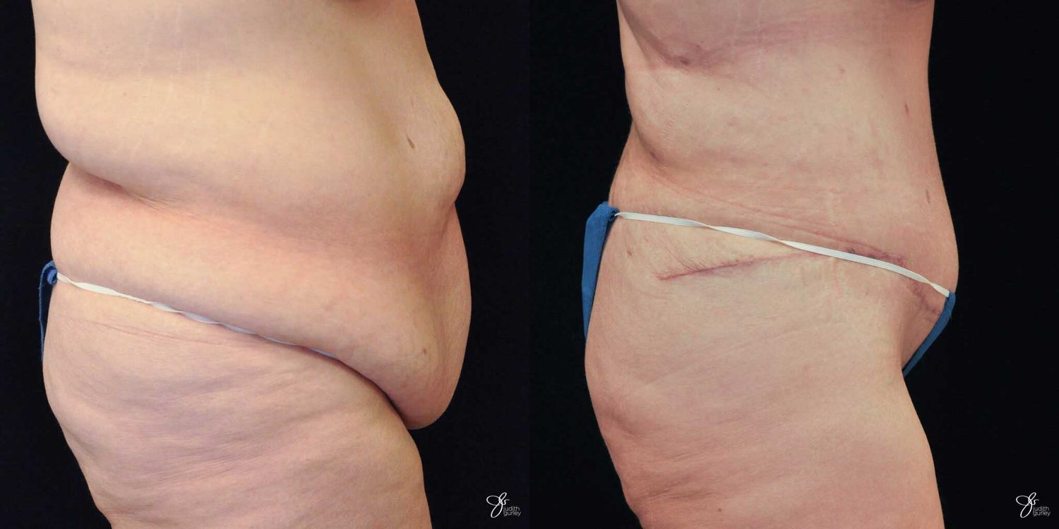 Body Lift Before & After
