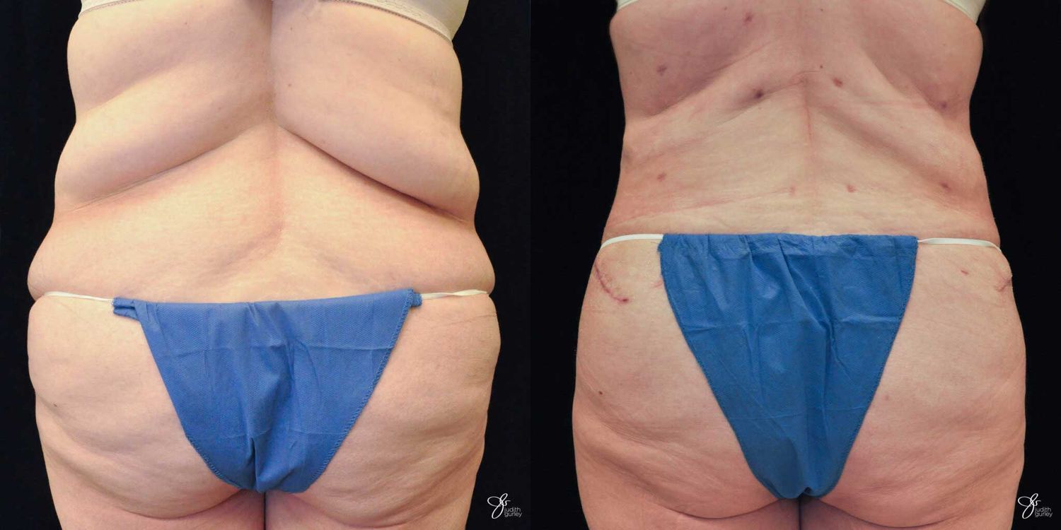 Body Lift Before & After