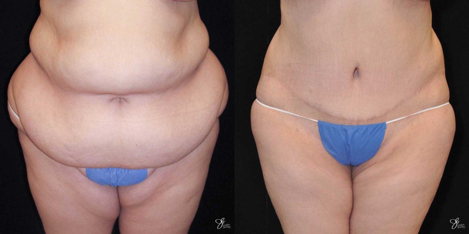 Body Lift Before & After