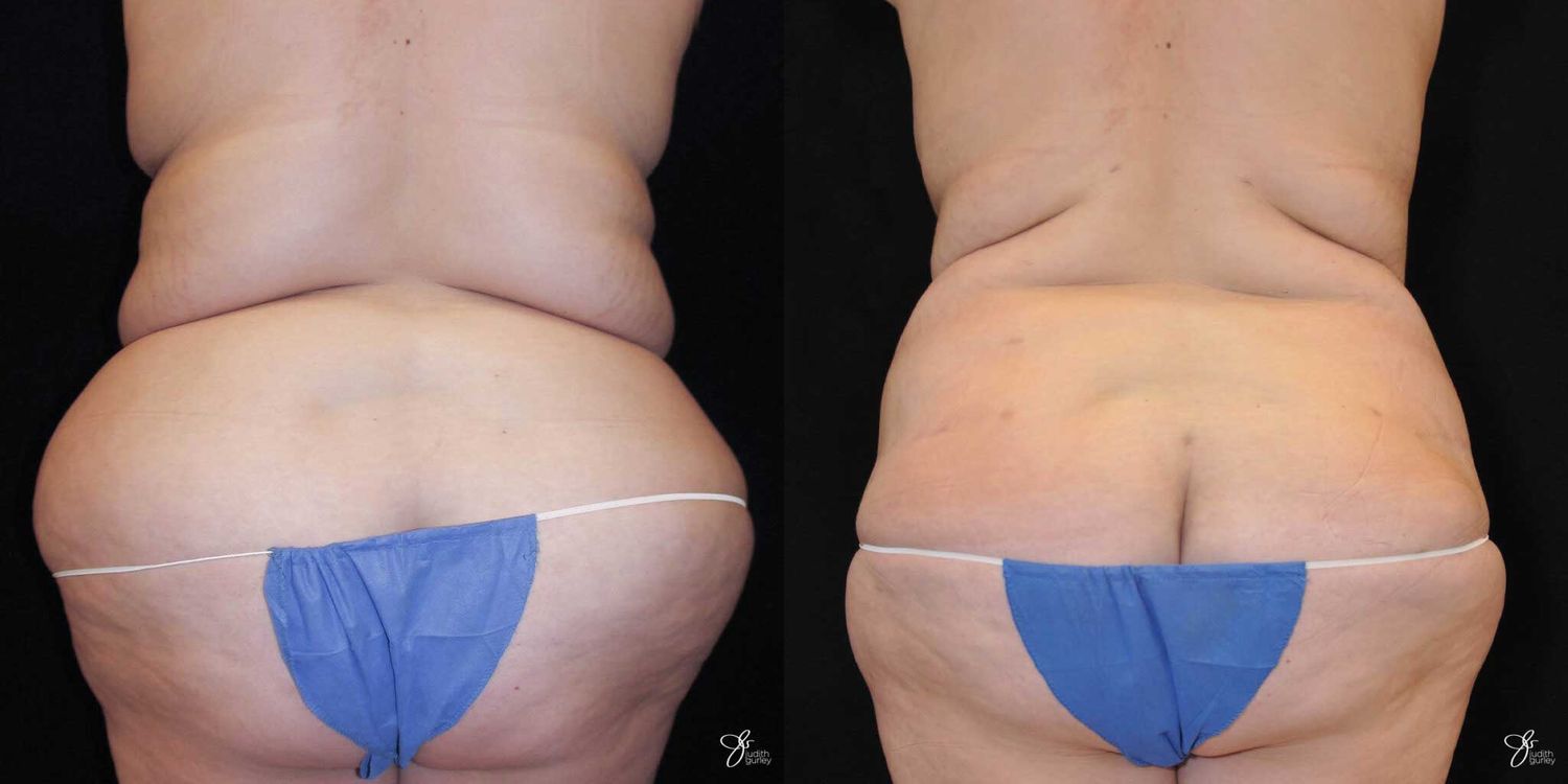 Body Lift Before & After
