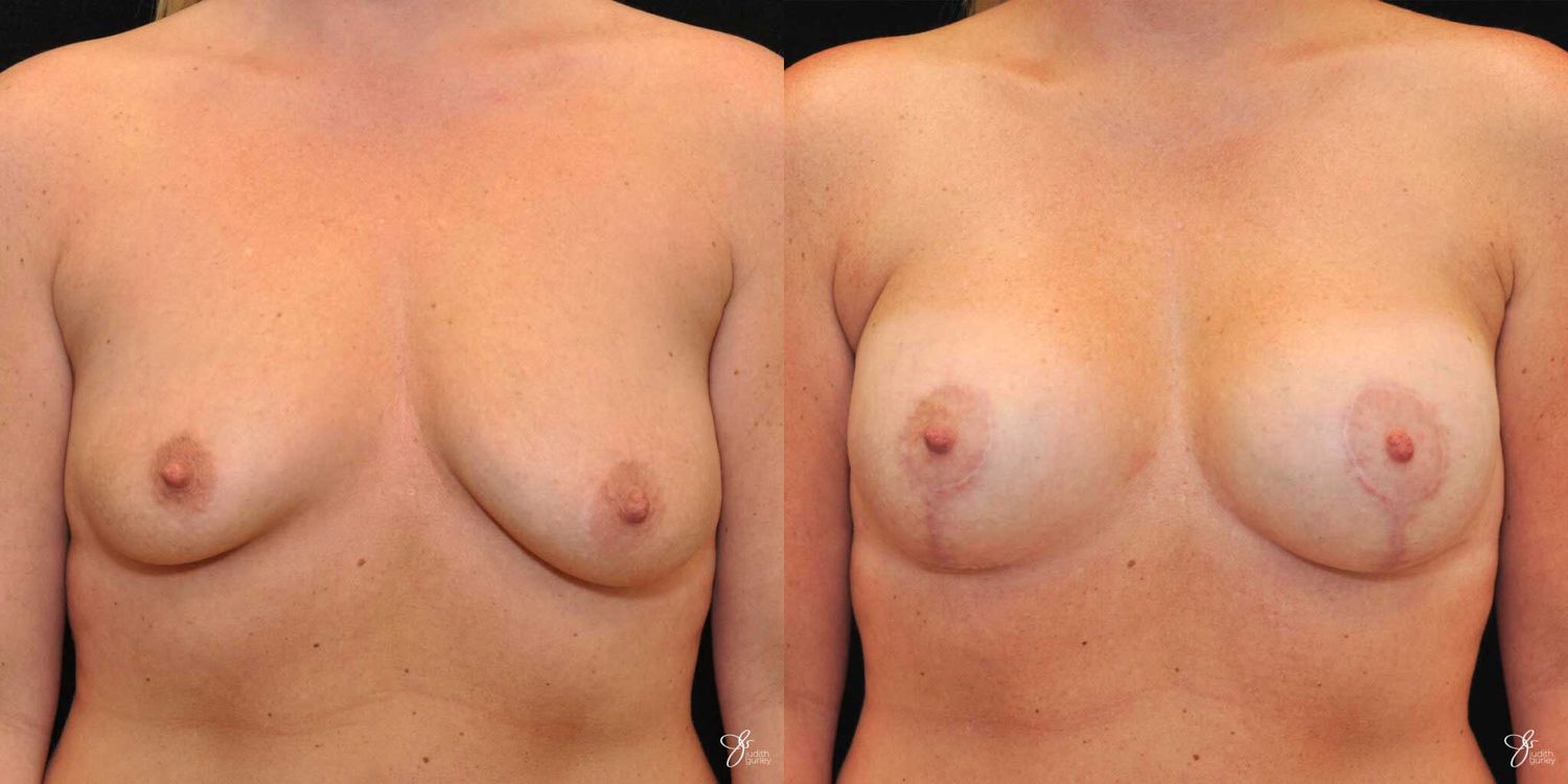 Asymmetry Correction Before & After