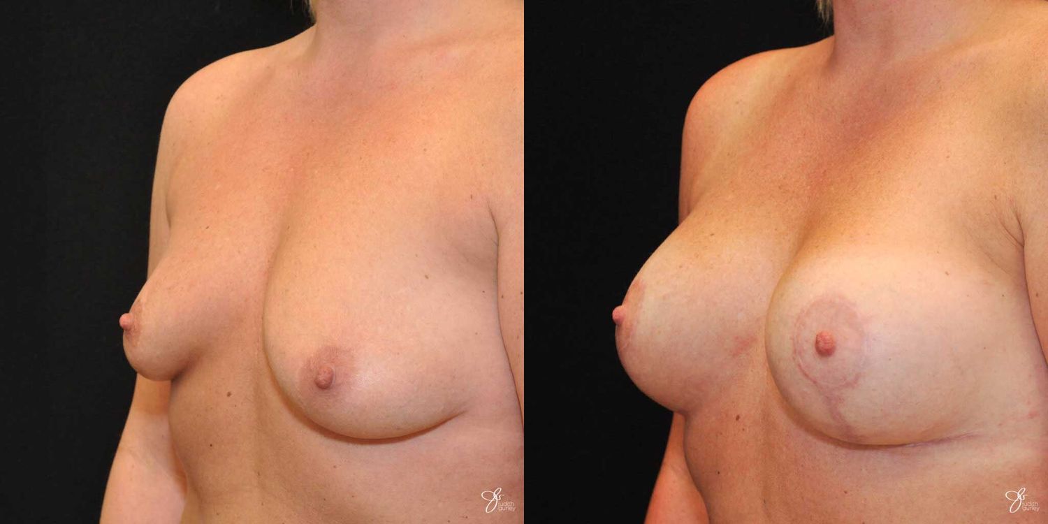 Asymmetry Correction Before & After