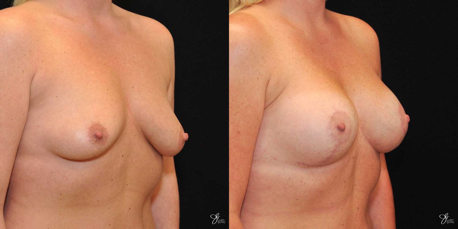 Asymmetry Correction Before & After