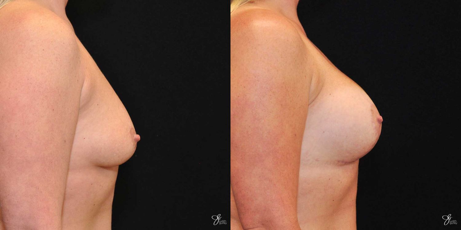 Asymmetry Correction Before & After