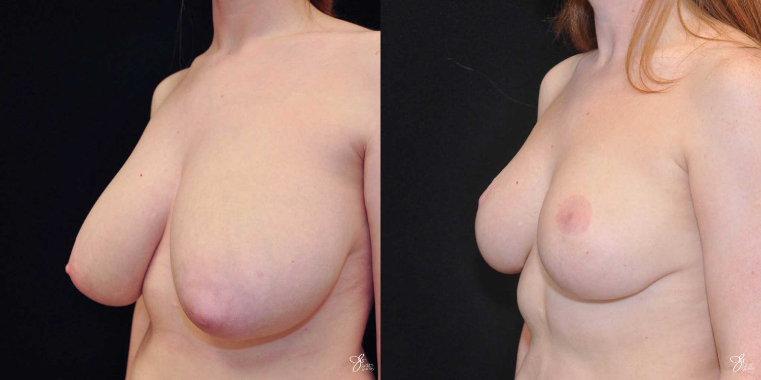 Asymmetry Correction Before & After