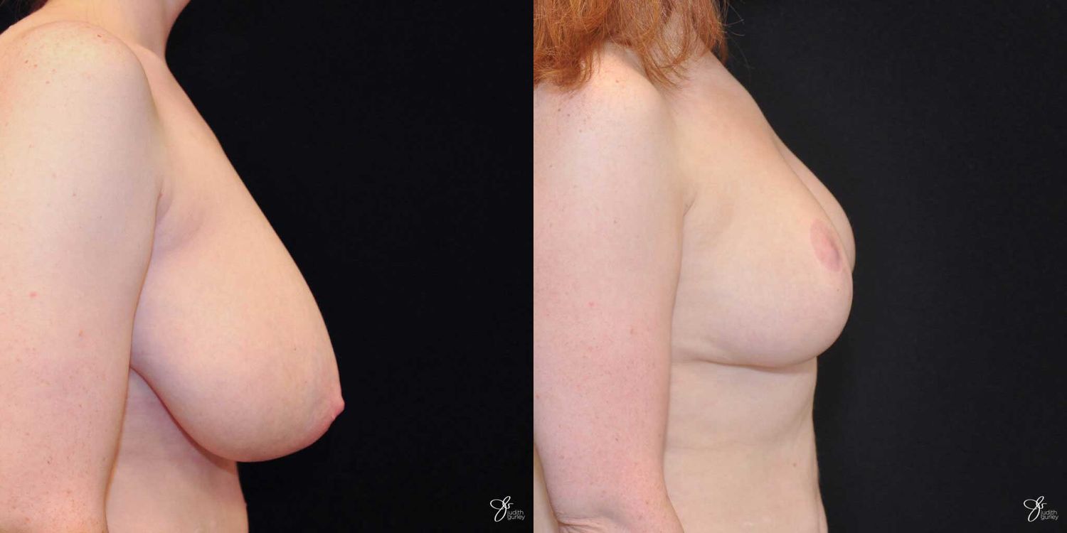 Asymmetry Correction Before & After