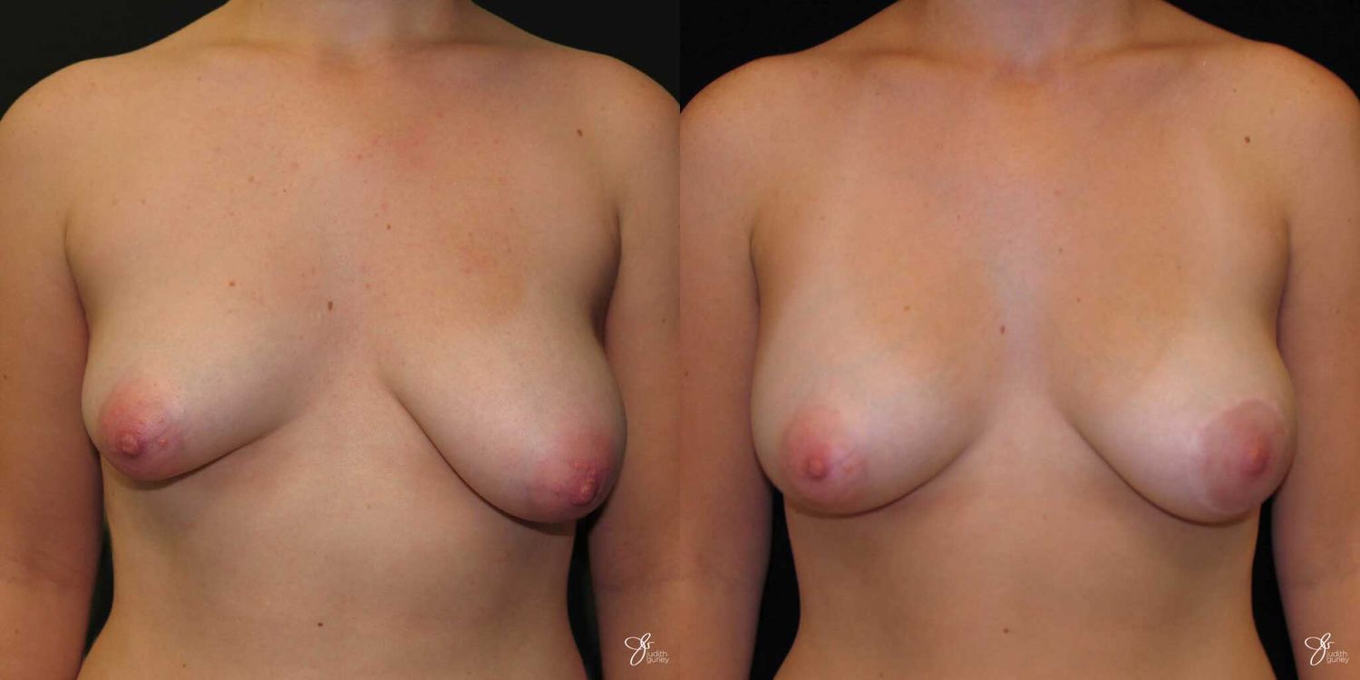 Asymmetry Correction Before & After