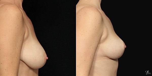 Breast Lift Before & After