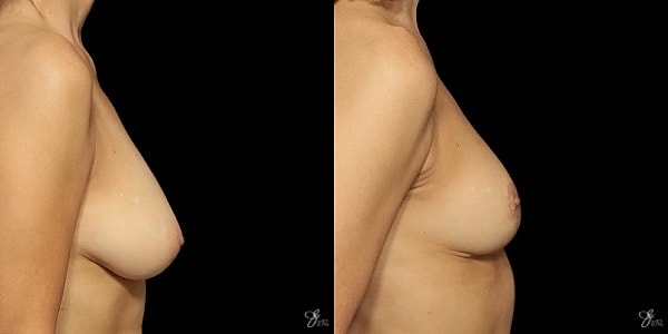Breast Lift Before & After