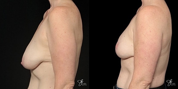 Breast Lift Before & After