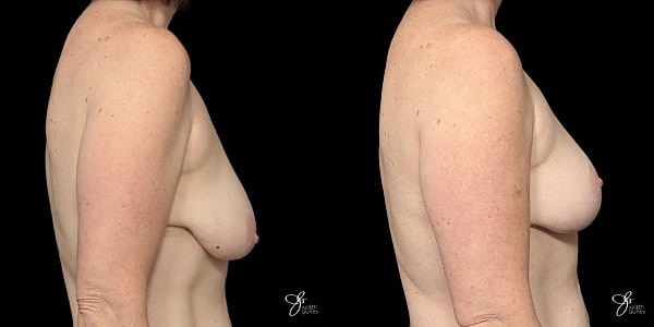 Breast Lift Before & After