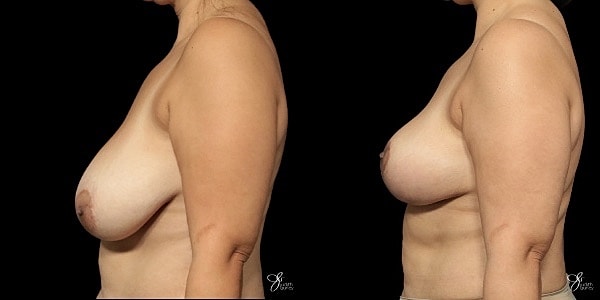 Breast Lift Before & After