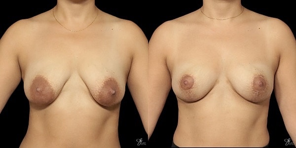 Breast Lift Before & After