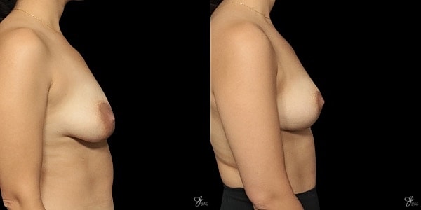 Breast Lift Before & After