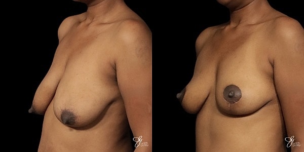 Breast Lift Before & After