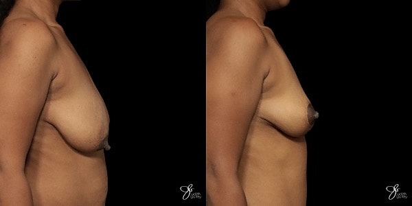 Breast Lift Before & After