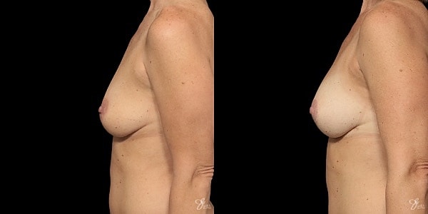 Breast Lift Before & After