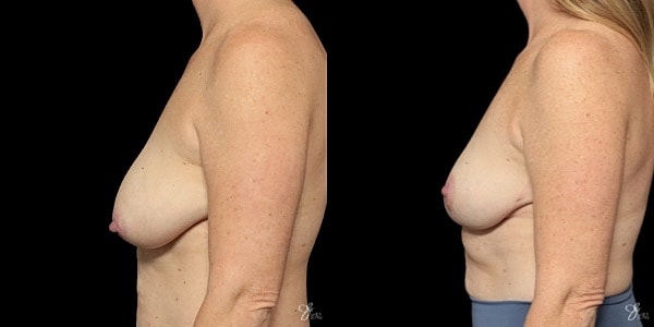 Breast Lift Before & After