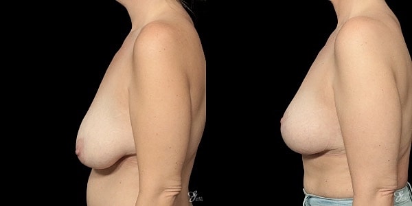 Breast Lift Before & After