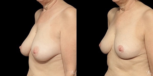 Breast Lift Before & After