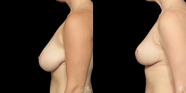 Breast Lift Before & After
